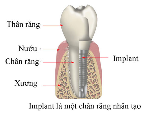 Kinh nghiệm làm răng implant - Top kinh nghiệm cho bạn 3