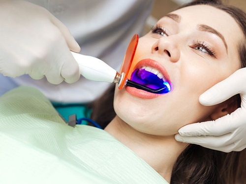 Tác hại của việc tẩy trắng răng bạn nên biết 3