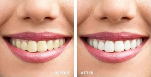 Tẩy trắng răng trong 1 tuần với nguyên liệu thiên nhiên 3