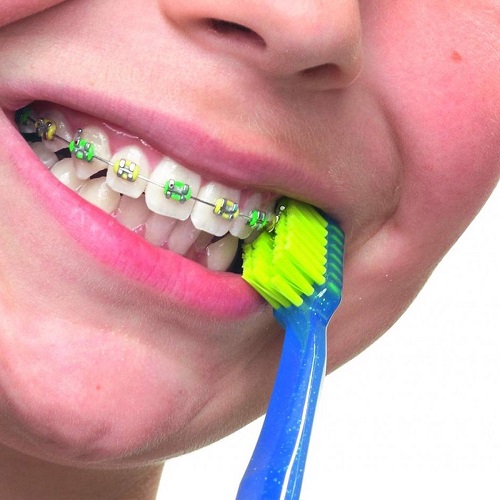 Niềng răng dùng bàn chải gì? Nha khoa gợi ý *