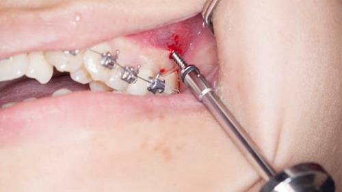 Cắm vít niềng răng có đau không bác sĩ chuyên khoa? 1