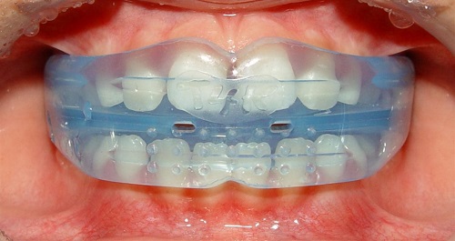 Dụng cụ niềng răng tại nhà 3 giai đoạn - Tìm hiểu thêm 3