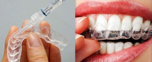 Tẩy trắng răng bằng máng có tốt không? Giải đáp thực tế 2