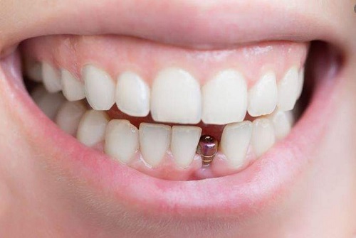 Trồng răng cửa hàm dưới cần lưu ý gì? 1 Trồng răng cửa hàm dưới cần lưu ý gì? 1