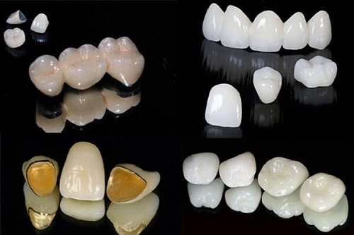 Trồng răng cửa hàm dưới cần lưu ý gì? 3 Trồng răng cửa hàm dưới cần lưu ý gì? 3