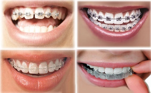 Niềng răng xong có nên tẩy trắng răng? Bác sĩ tư vấn 1