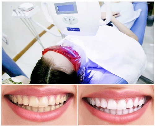 Niềng răng xong có nên tẩy trắng răng? Bác sĩ tư vấn 2