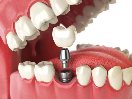 Trồng răng có chân răng - Giải pháp tối ưu cho bạn 1