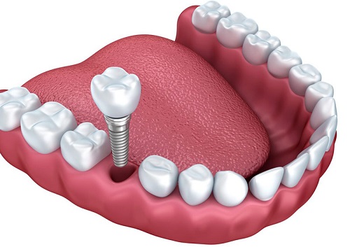 Trồng răng có chân răng - Giải pháp tối ưu cho bạn 2