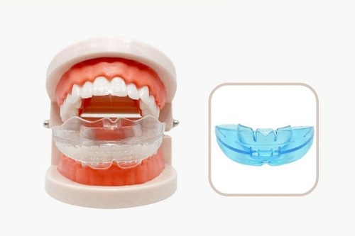 Dụng cụ niềng răng tại nhà có tốt không? 2