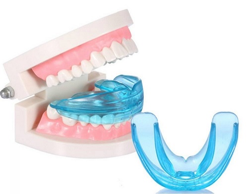 Dụng cụ niềng răng tại nhà có tốt không? 3