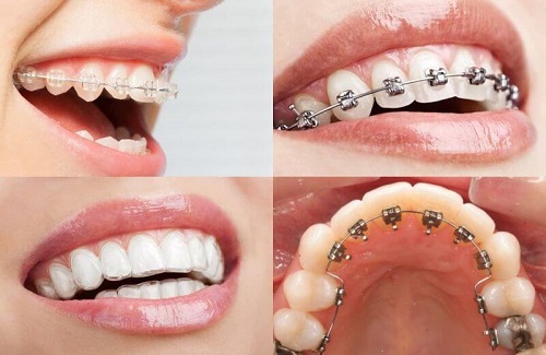 Niềng răng lúc nào đau nhất? Các giai đoạn bạn phải trải qua 2