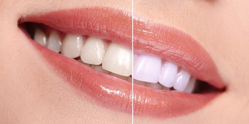 Sản phẩm làm trắng răng an toàn hiệu quả bất ngờ 1