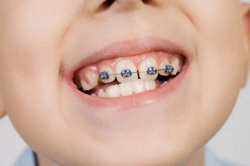 Niềng răng cho trẻ em có đau không? Tham khảo ngay 1