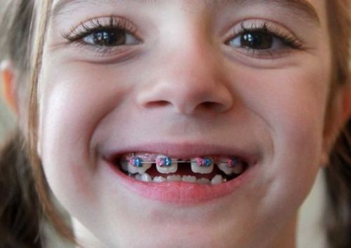 Niềng răng cho trẻ em ở đâu tpHCM là chất lượng? 1