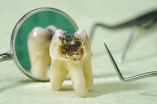 Răng khôn hàm trên bị sâu nên nhổ hay không? 3 Răng khôn hàm trên bị sâu nên nhổ hay không? 3